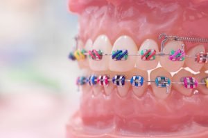 Some Known Factual Statements About Orthodontics 