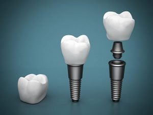 Dental Implants | Dentist Mayfield