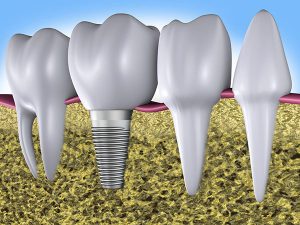 Implant Dentistry | Dentist Mayfield