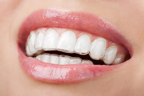 invisalign aspendale