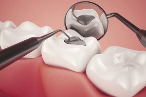 Lost Damaged Tooth Fillings Dental Emergency | Dentist Mayfield