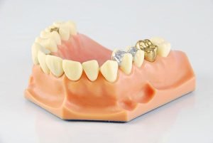 Lost or Damaged Dental Crown Inlays and Onlays