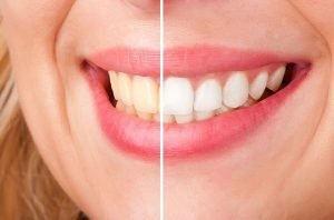 Teeth Whitening | Dentist Mayfield