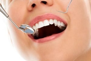 Tooth Coloured Fillings | Dentist Mayfield