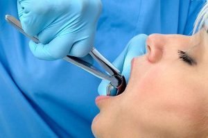 Tooth Extraction | Dentist Mayfield