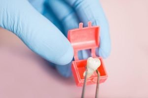 Wisdom Teeth Removal | Dentist Mayfield