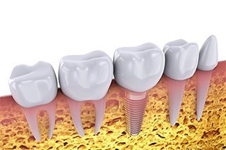 Dental Implants Procedure In Mayfield